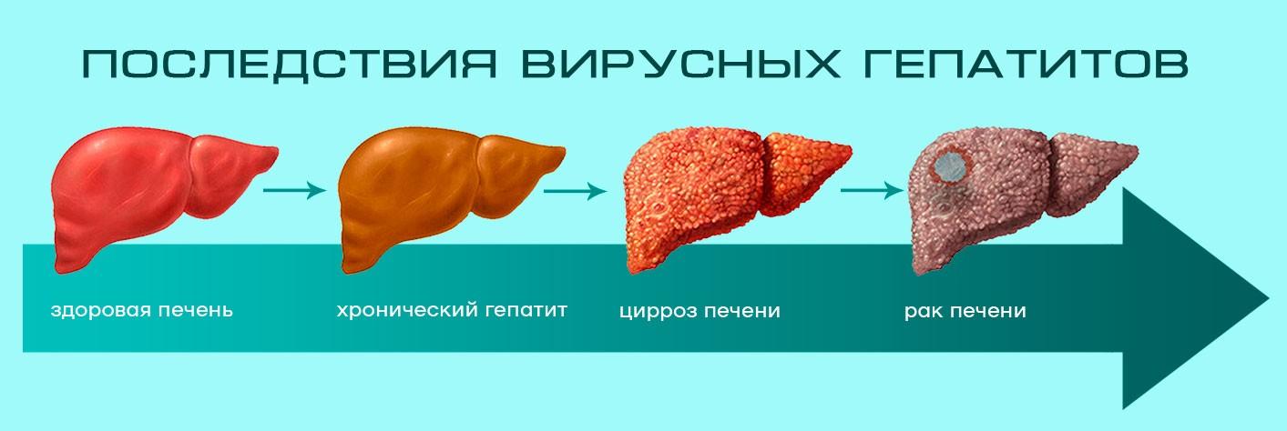 последствия-гепатита